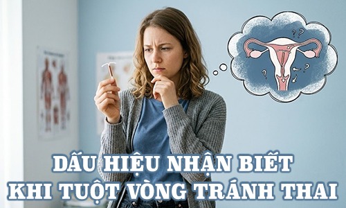 Dấu hiệu nhận biết khi tuột vòng tránh thai